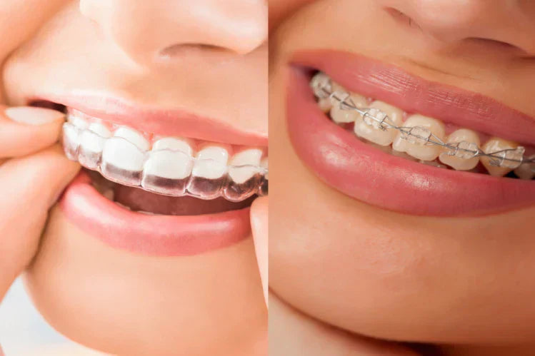 An image of two girls smiling. One with white braces and the other with clear braces.