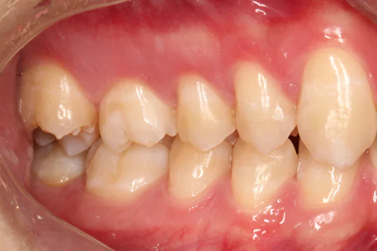 Close-up of posterior teeth