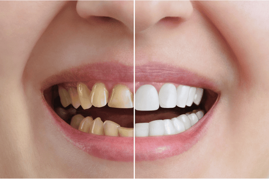 Teeth whitening