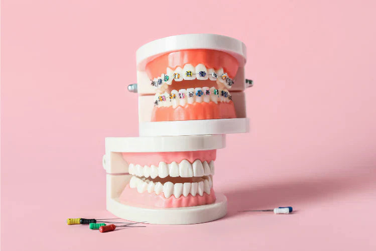 An image of dental models with and without fake braces