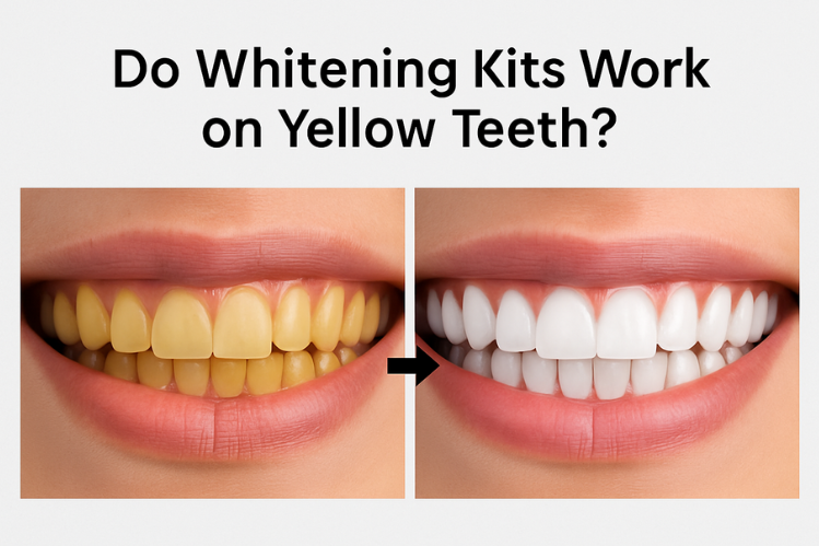 A before-and-after image of teeth from yellow to white