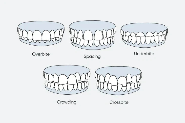 An illustration of different types of misaligned teeth