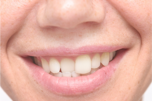 Close-up of a person smiling to show crooked teeth