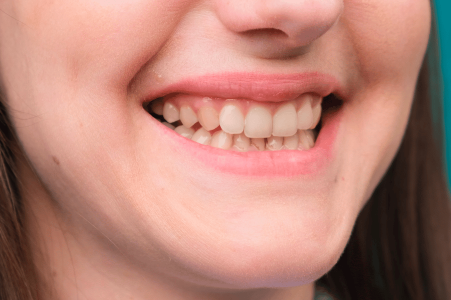 Clear Aligners & Enamel Protection During Orthodontic Treatment