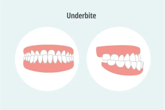 front and side representation of how underbite looks like