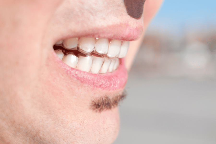 How to Manage Orthodontic Treatment with Sensitivities