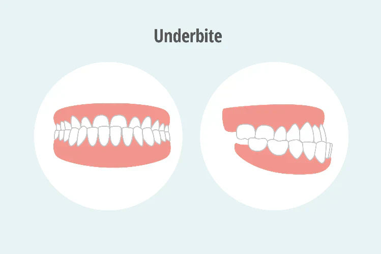 An illustration of an underbite (class 3 bite)