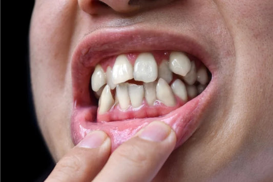 A person showing their crooked front teeth