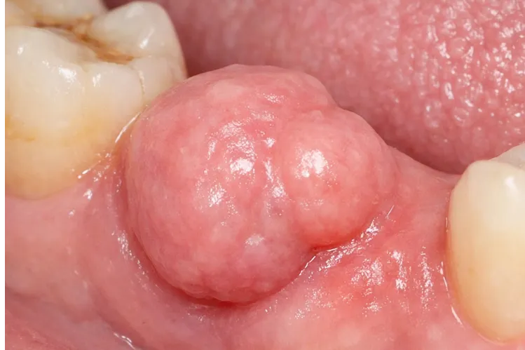  A close of dental odontoma 