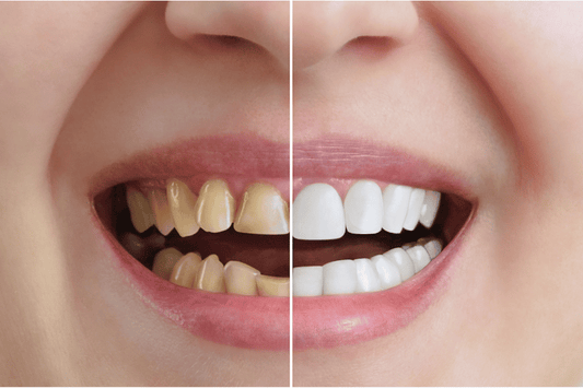 Teeth whitening