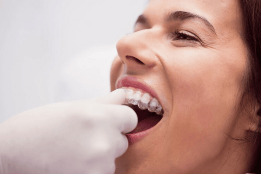 clear aligners for teeth straightening.