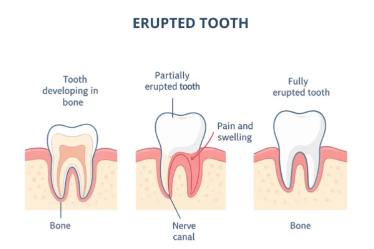 Erupted Tooth: What It Means & Possible Issues