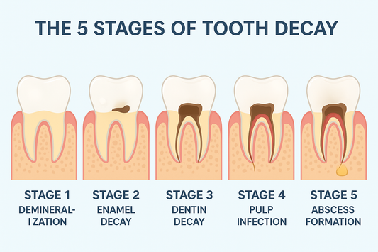The five stages of tooth decay 