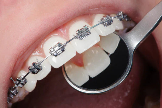 A girl is wearing metal braces