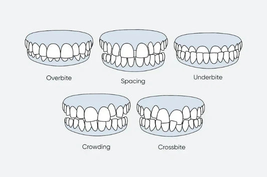 An illustration of different types of misaligned teeth 