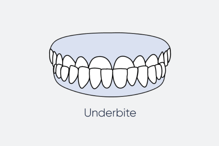 An illustration of an underbite