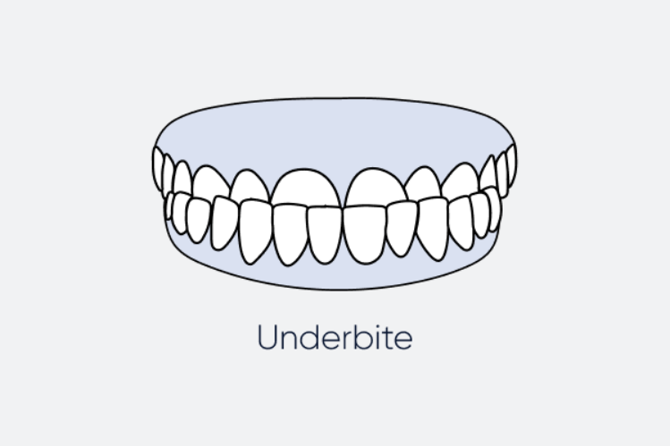An illustration showing an underbite.