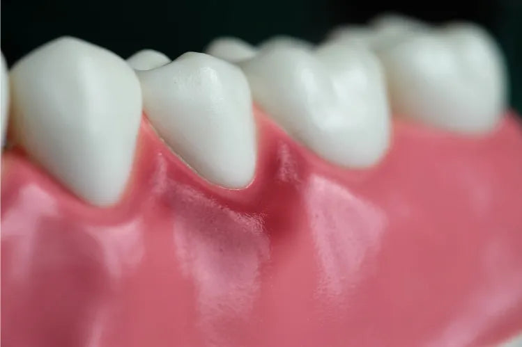  Dental model highlighting early gum disease (gingivitis) with inflamed gum tissue