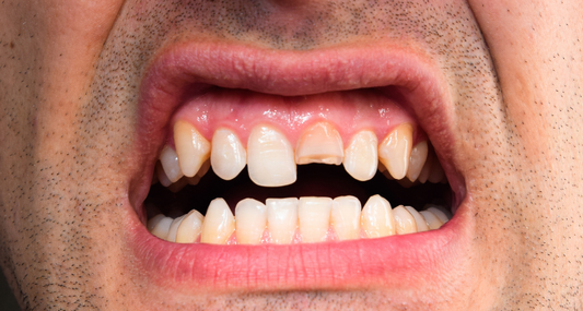 A person with a broken tooth after severe grinding.