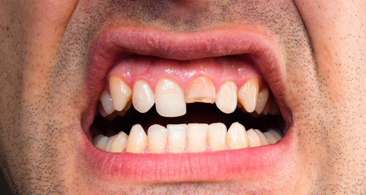 A person with a broken tooth after severe grinding.