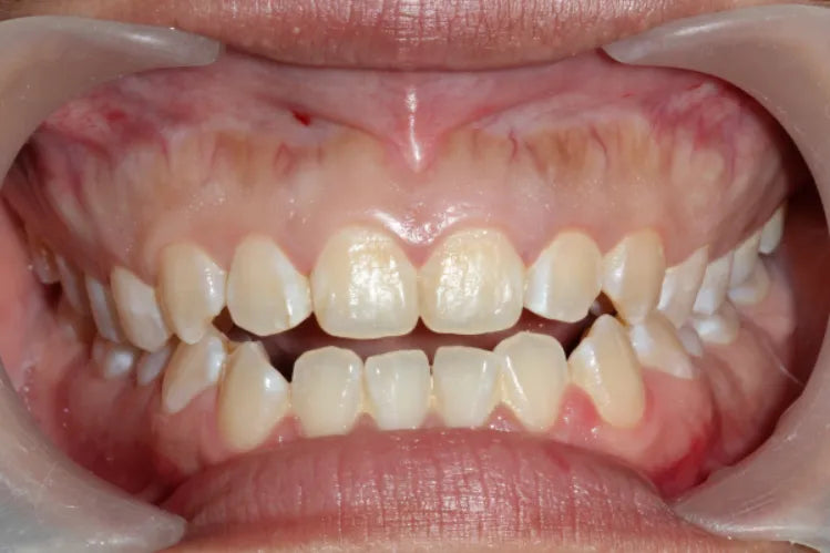 A close-up image showing an anterior open bite.