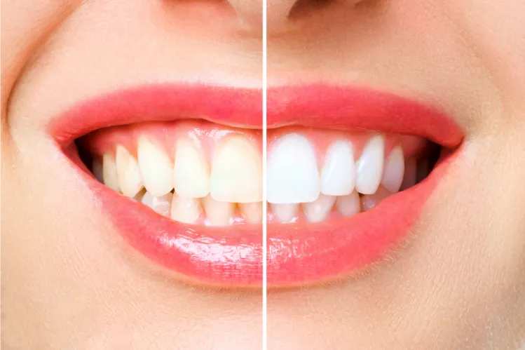 Before and after teeth whitening.