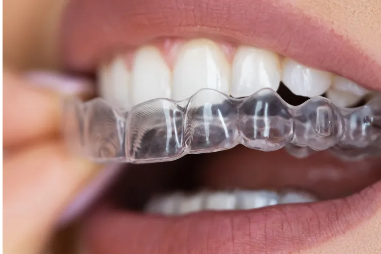  A girl applying a dental night guard for teeth grinding.