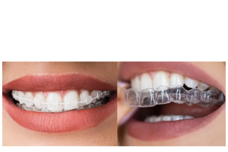 White braces vs clear braces
