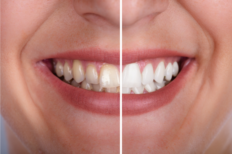 Woman's teeth before and after whitening 