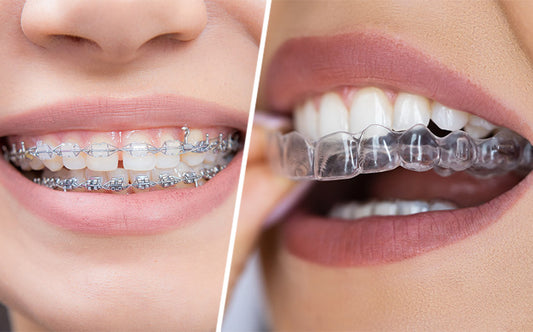 Clear Braces vs Metal Braces – What’s The Better Choice?