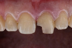 Why are My Teeth Chipping? Causes and Treatment