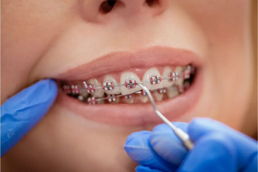 Fixing the broken braces