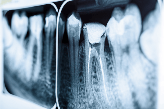 Teeth Straightening 
