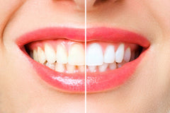 Teeth Polishing vs. Teeth Whitening: What's the Difference? Get the Facts Here!